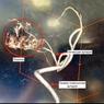 

Сильная головная боль оказалась редкой опухолью: как врачи Александровской больницы спасли пациента image
