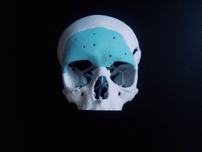 

В ДГБ № 5 им. Н. Ф. Филатова состоялась уникальная операция по исправлению дефекта черепа при помощи специального материала гидроксиапатита image
